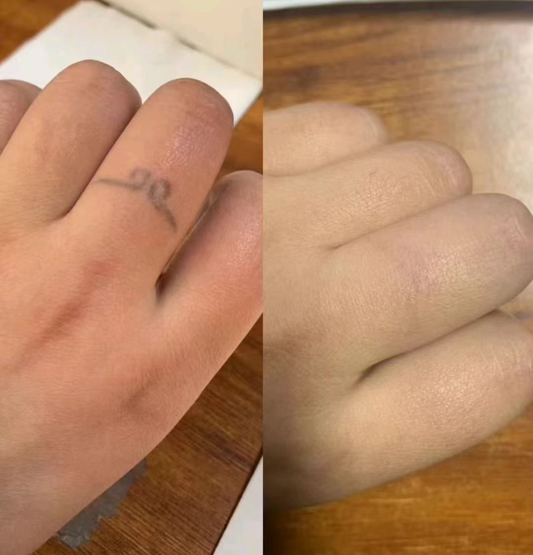 中国专业一次性洗纹身体验店