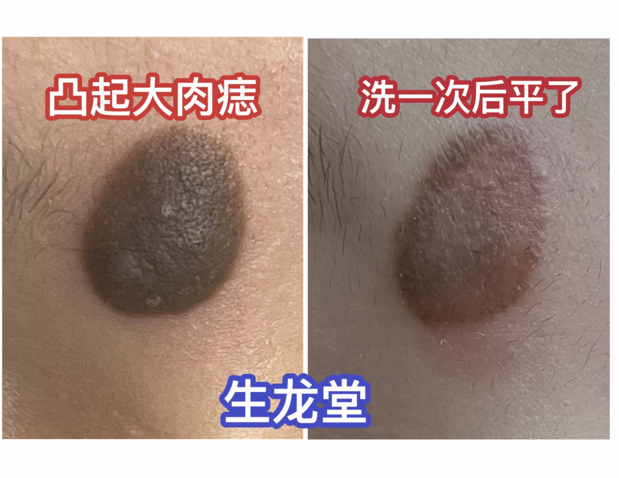 生龙堂刺青(大功率超皮秒)洗纹身馆